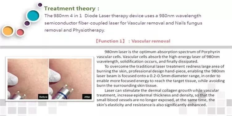 BEST 30W 5 in 1 980nm Diode Laser Vascular Removal Machine Remove Spider Veins 980 Diode Laser Blood Vessels Removal Nail Fungus