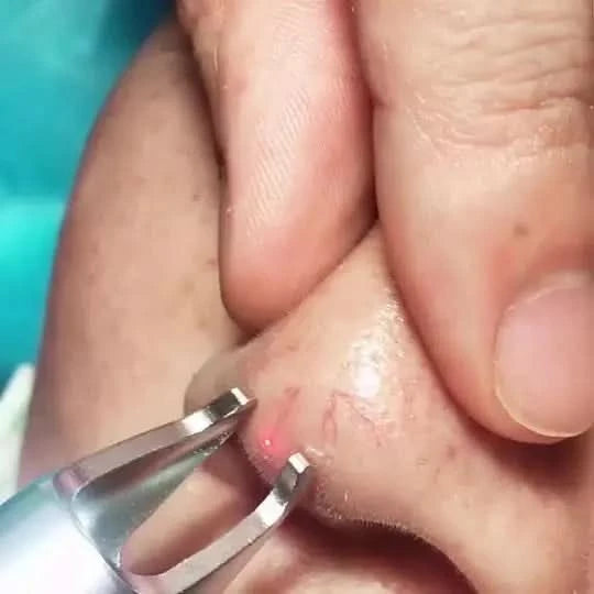 BEST 30W 5 in 1 980nm Diode Laser Vascular Removal Machine Remove Spider Veins 980 Diode Laser Blood Vessels Removal Nail Fungus