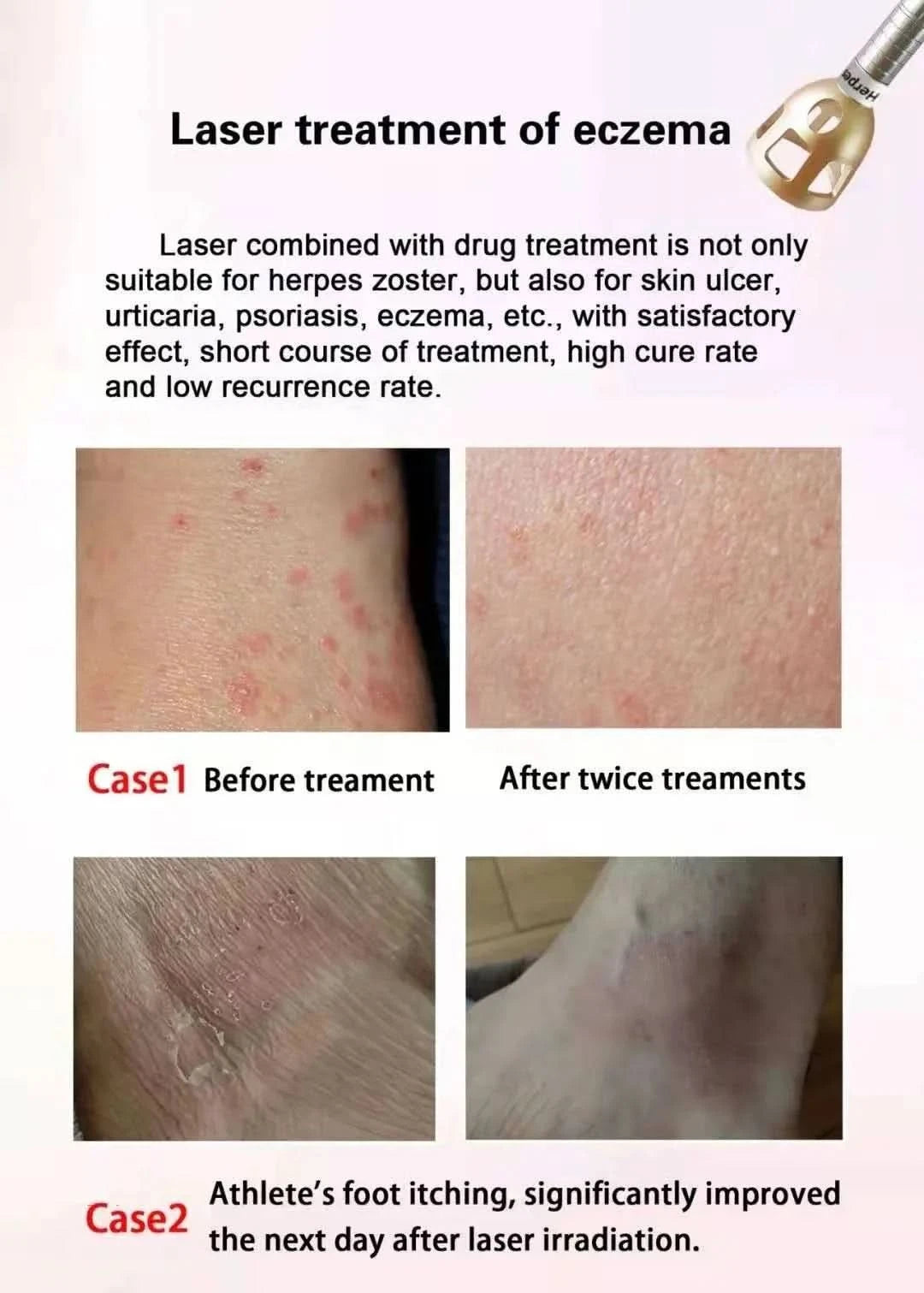 BEST 30W 5 in 1 980nm Diode Laser Vascular Removal Machine Remove Spider Veins 980 Diode Laser Blood Vessels Removal Nail Fungus